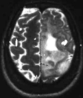Motorfunktion bei Gliom, T2 mit Einblendung f-MRI