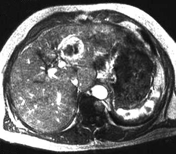 hepatozellulres Karzinom, T1 axial, frhe Postkontrastaufnahme