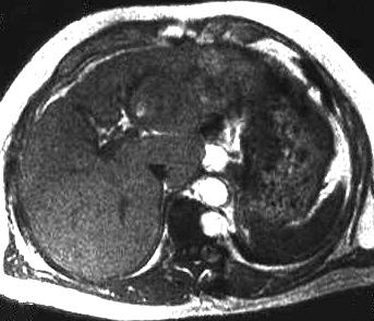 hepatozellulres Karzinom, T1 axial