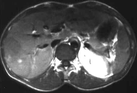 Lymphom der Leber, T1 axial