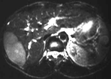 Lymphom der Leber, T2 axial