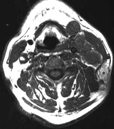 Lymphome einseitig, T1-gewichtet axial