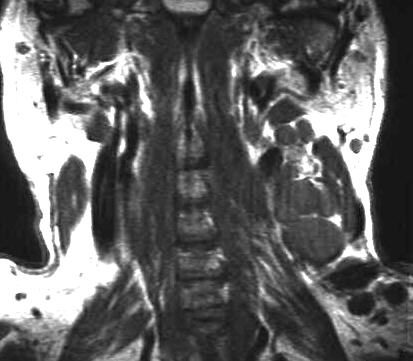 Lymphome einseitig, T1-gewichtet coronal