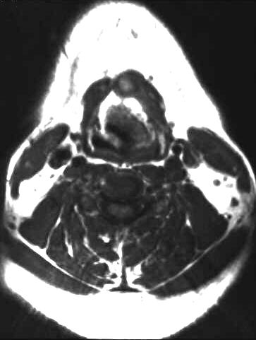 Larynxkarzinom, T1-gewichtet axial