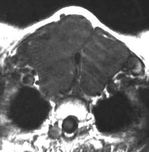 Struma nodosa, T1-gewichtet axial