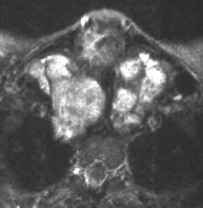 Struma nodosa, T2-gewichtet