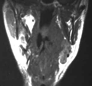 Tonsillenkarzinom, T1-gewichtet coronal