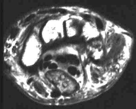 Neurom des N. medianus, T1 i.v. KM axial