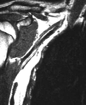 normaler Plexus brachialis, T1 frontal