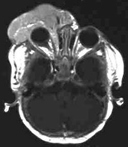 Haemangiom der Orbita, T1 i.v. KM, axial