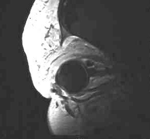 Haemangiom der Orbita, T1 i.v. KM, sagittal, Oberflchenspule