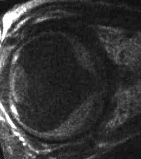 Angiomatose der Netzhaut, T1 sagittal, Augenspule