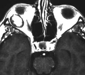 Cavernom der Orbita, T1 i.v. KM, axial