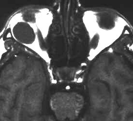 Cavernom der Orbita, T1, axial