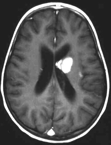 intracerebrale Blutung T1 i.v. KM