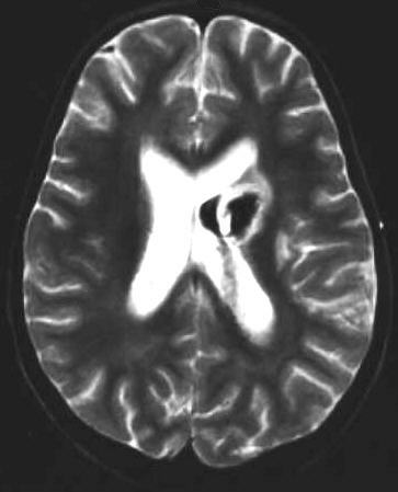 intracerebrale Blutung T2