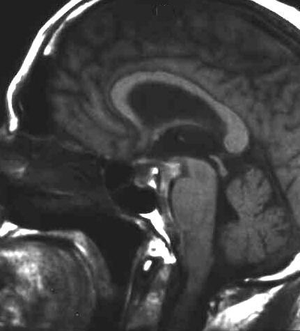 subarachnoidale Blutung T1 sagittal