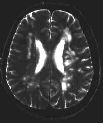 vaskulre Encephalopathie T2