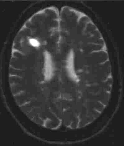 Encephalomyelitis disseminata T2