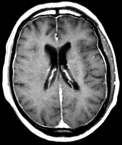 Meningitis T1 i.v. KM