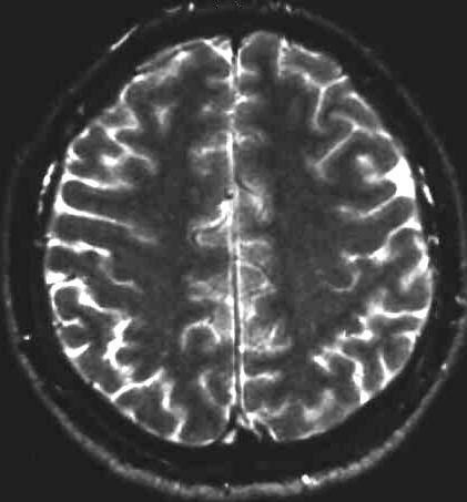 Leukencephalopathie 1 Jahr zuvor