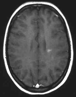 Encephalomyelitis disseminata T1 i.v. KM