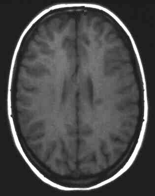 Encephalomyelitis disseminata T1