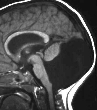 Dandy-Walker-Zyste T1 sagittal