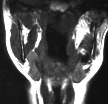 Speicheldrsenstein submandibulr, T1 frontal