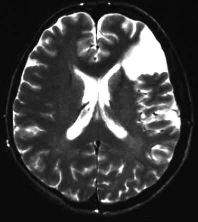 teilresorbierter Infarkt T2