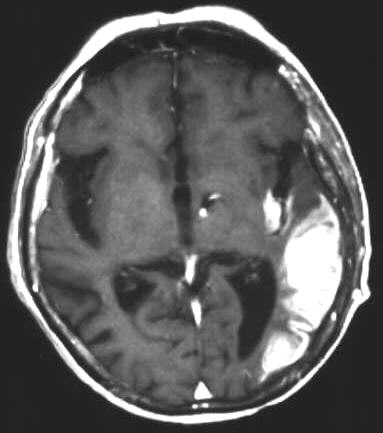 haemorrhagischer Infarkt nach i.v. KM T1