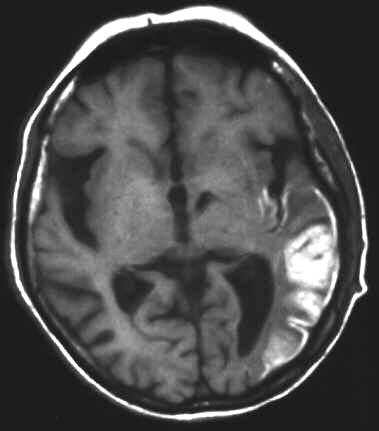 haemorrhagischer Infarkt T1