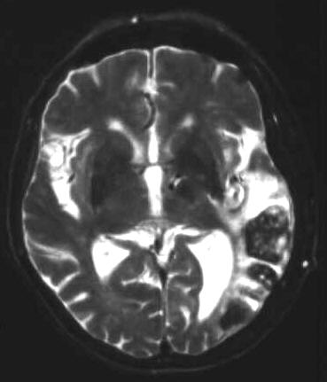 haemorrhagischer Infarkt T2