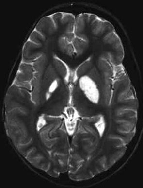 Stammganglieninfarkt T2