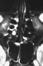 Sinusitis sphenoidalis et ethmoidalis, T2