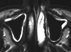 Sinusitis maxillaris, T2