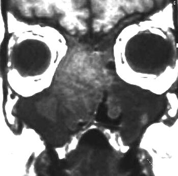 Papillom und Sinusitis, T1-gewichtet