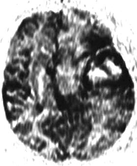 Gliom IV.Grades, MR-Perfusionsstudie, Hyperperfusion des Tumorrandwalles