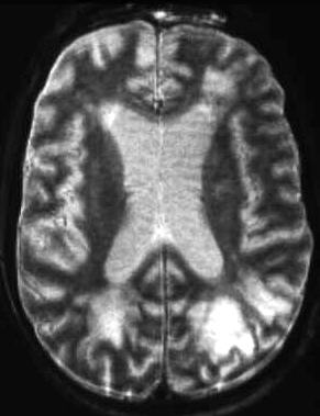 Infiltration des Marklagers durch Lymphom T2