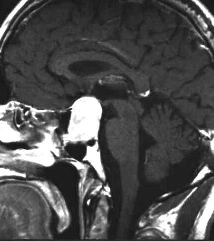 Hypophysenmakroadenom  T1 i.v. KM sagittal