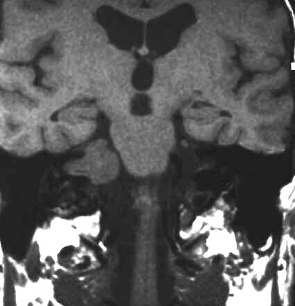 Akustikusneurinom T1 coronal