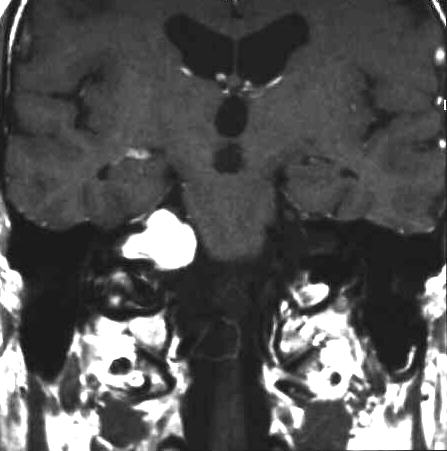 Akustikusneurinom T1 i.v. KM