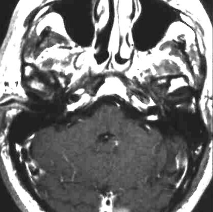 Akustikusneurinom T1 i.v. KM