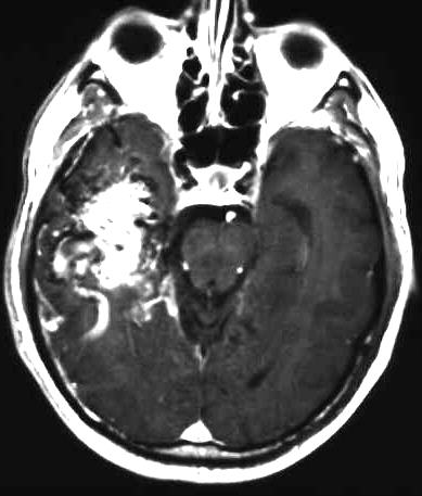 arteriovense Malformation T1 i.v. KM