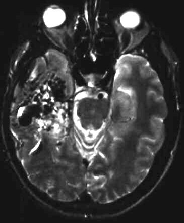 arteriovense Malformation T2