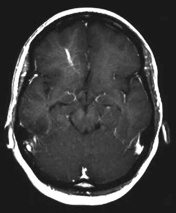 vense Malformation T1 i.v. KM