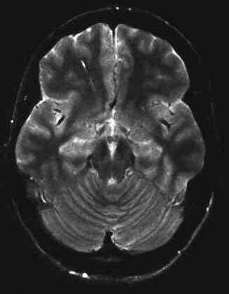 vense Malformation T2