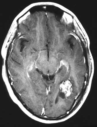 cavernse Malformation T1 nach i.v. KM