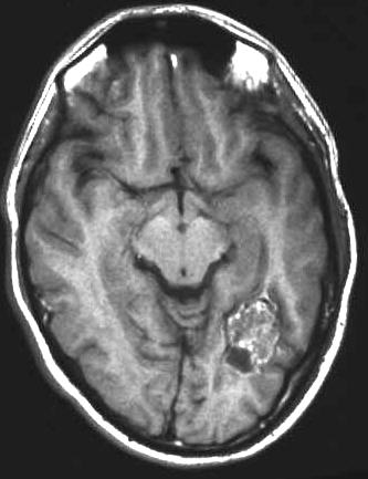 cavernse Malformation T1