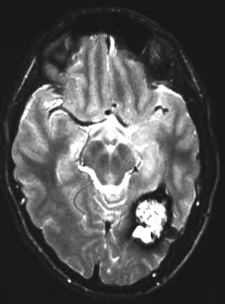 cavernse Malformation T2